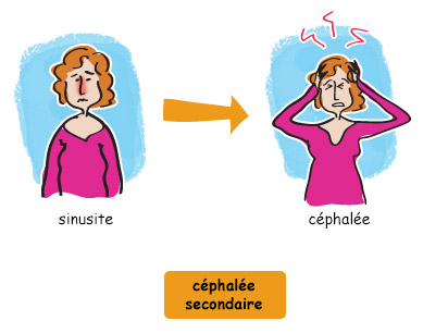 Différents maux de tête : céphalées secondaires - Migraine