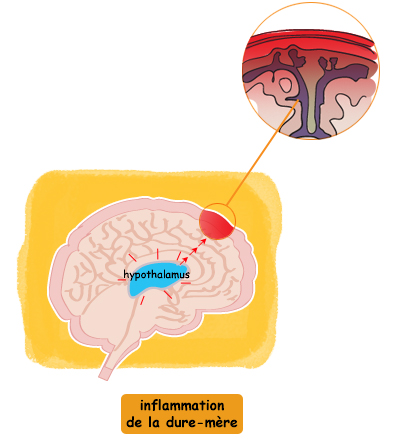 Crise migraineuse