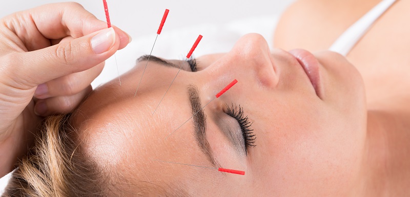 migraine acupuncture