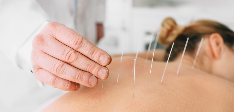 L'acupuncture serait efficace pour prévenir la migraine.